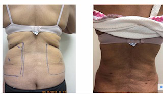 Lovehandles Renuvion/J plasma Drew Varano MD Lovehandles Renuvion/J plasma Drew Varano MD